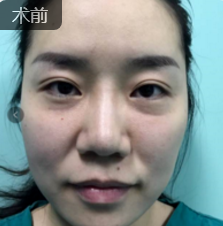 面部提升术
