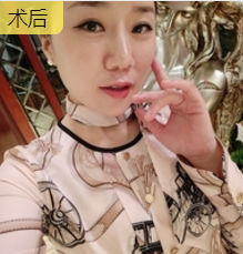 面部提升术