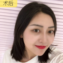 面部提升术