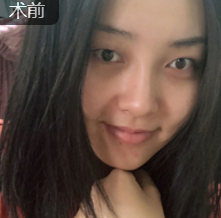 面部提升术