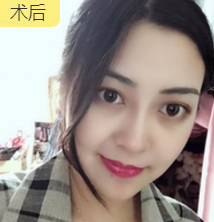 面部提升术
