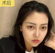 面部提升术