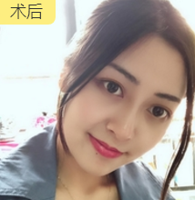 面部提升术