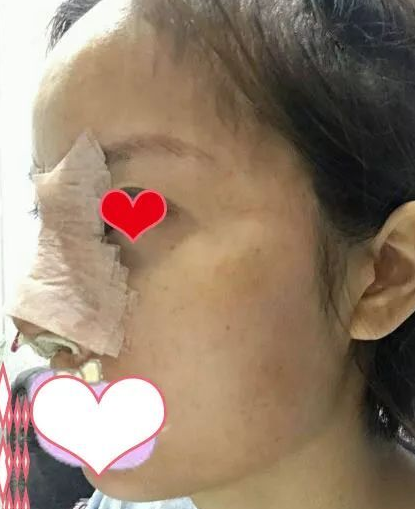 隆鼻手术