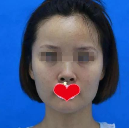 隆鼻手术