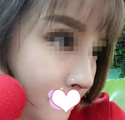 隆鼻手术