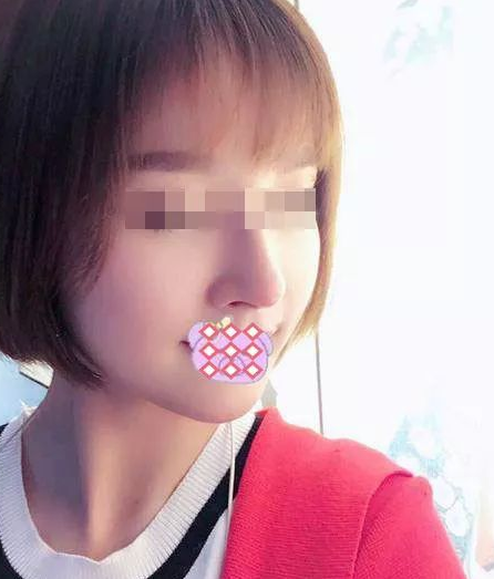 隆鼻手术
