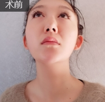 隆鼻手术