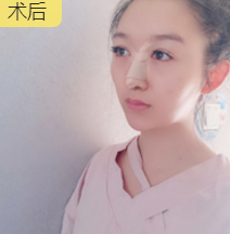 隆鼻手术