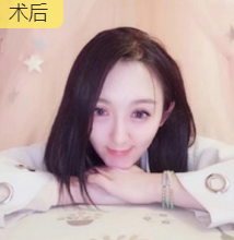 隆鼻手术