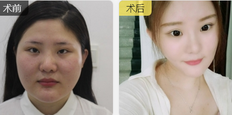 超声波瘦脸