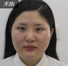 超声波瘦脸