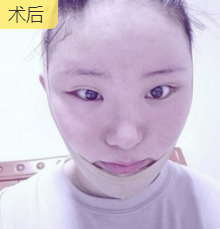 超声波瘦脸