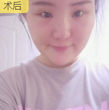 超声波瘦脸