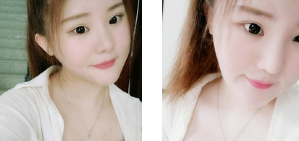 超声波瘦脸