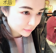 去双下巴