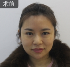去双下巴