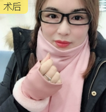 去双下巴