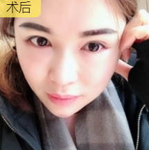 去双下巴