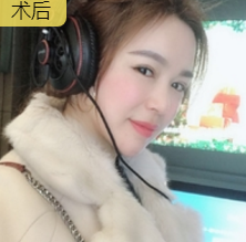 去双下巴