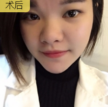 面部提升术