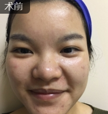 面部提升术