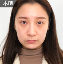 面部提升术