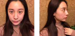 面部提升术