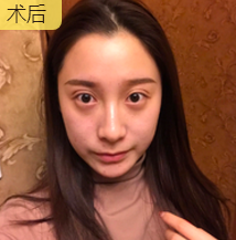 面部提升术