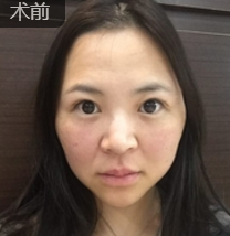 面部提升术