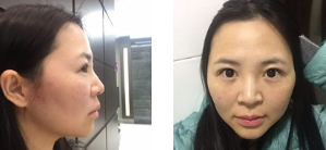 面部提升术