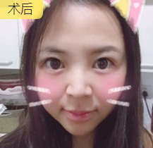 面部提升术