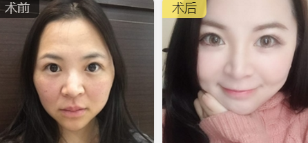 面部提升术