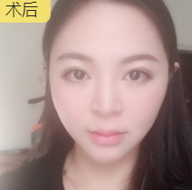 面部提升术