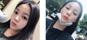 面部提升术