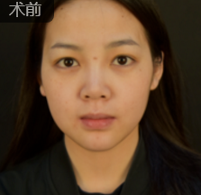 面部提升术