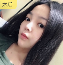 面部提升术