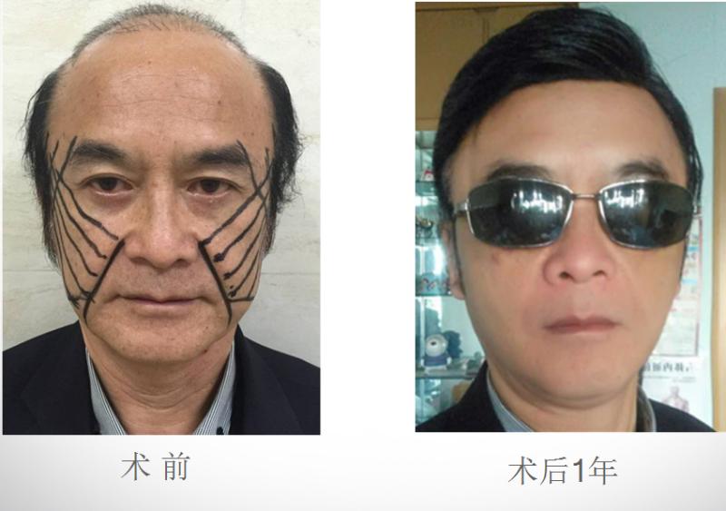面部提升术