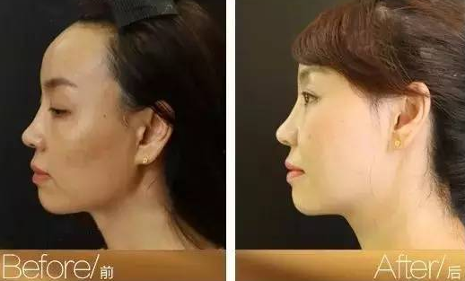 超级微拉美
