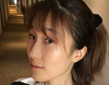 隆鼻手术
