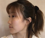 隆鼻手术