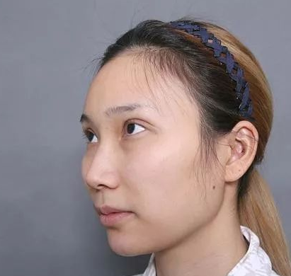超声波瘦脸