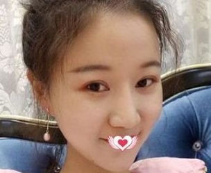 超声波瘦脸