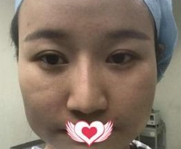 超声波瘦脸