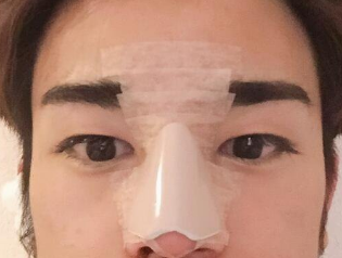 隆鼻手术