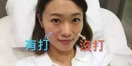 自体脂肪填充术