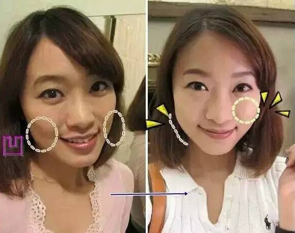 自体脂肪填充术