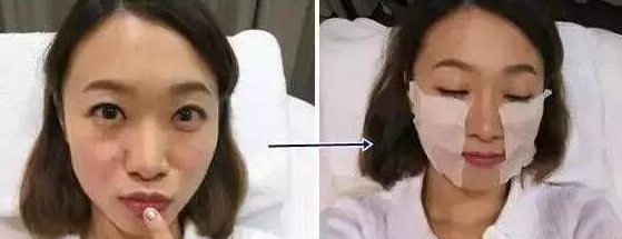 自体脂肪填充术