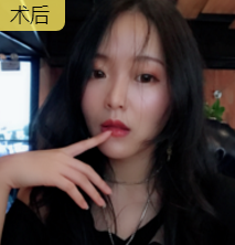 面部提升术