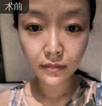 面部提升术